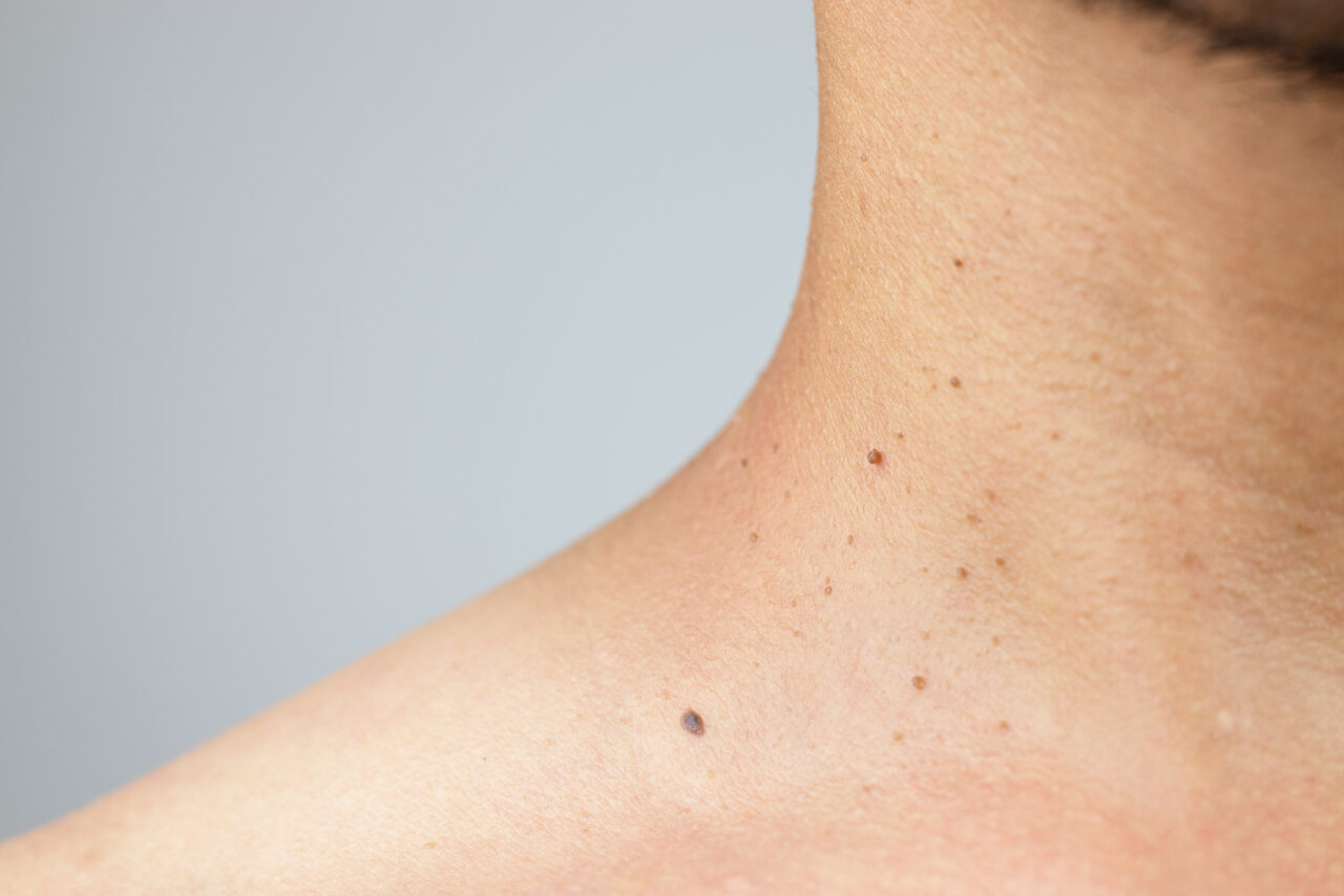 Skin Tags NEDA Skin Solutions Dermatology