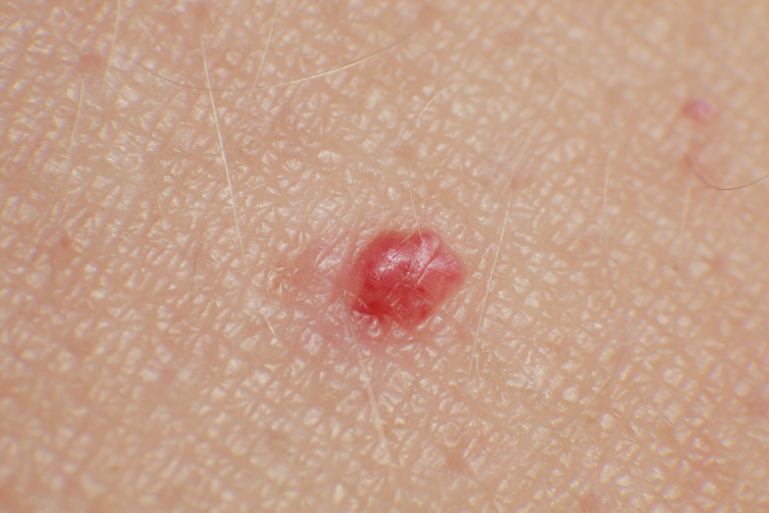 acne - NEDA Skin Solutions | Dermatology About Flexile Classic