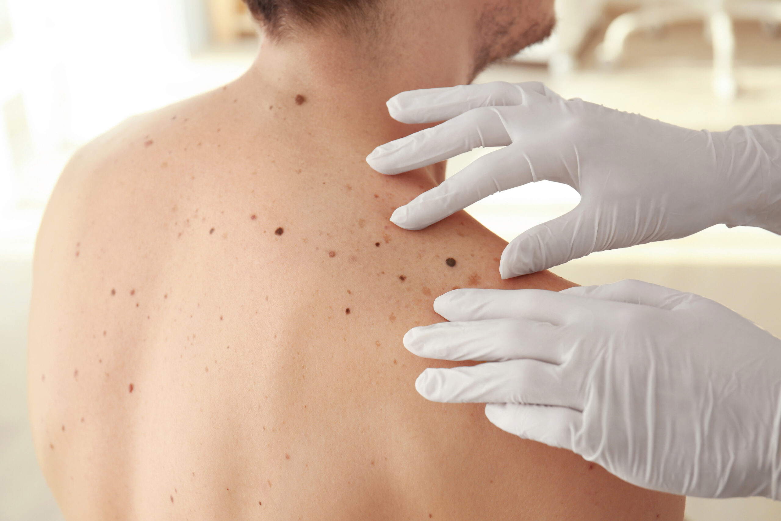 Skin Cancer Awareness Month: What You Need to Know About Melanoma