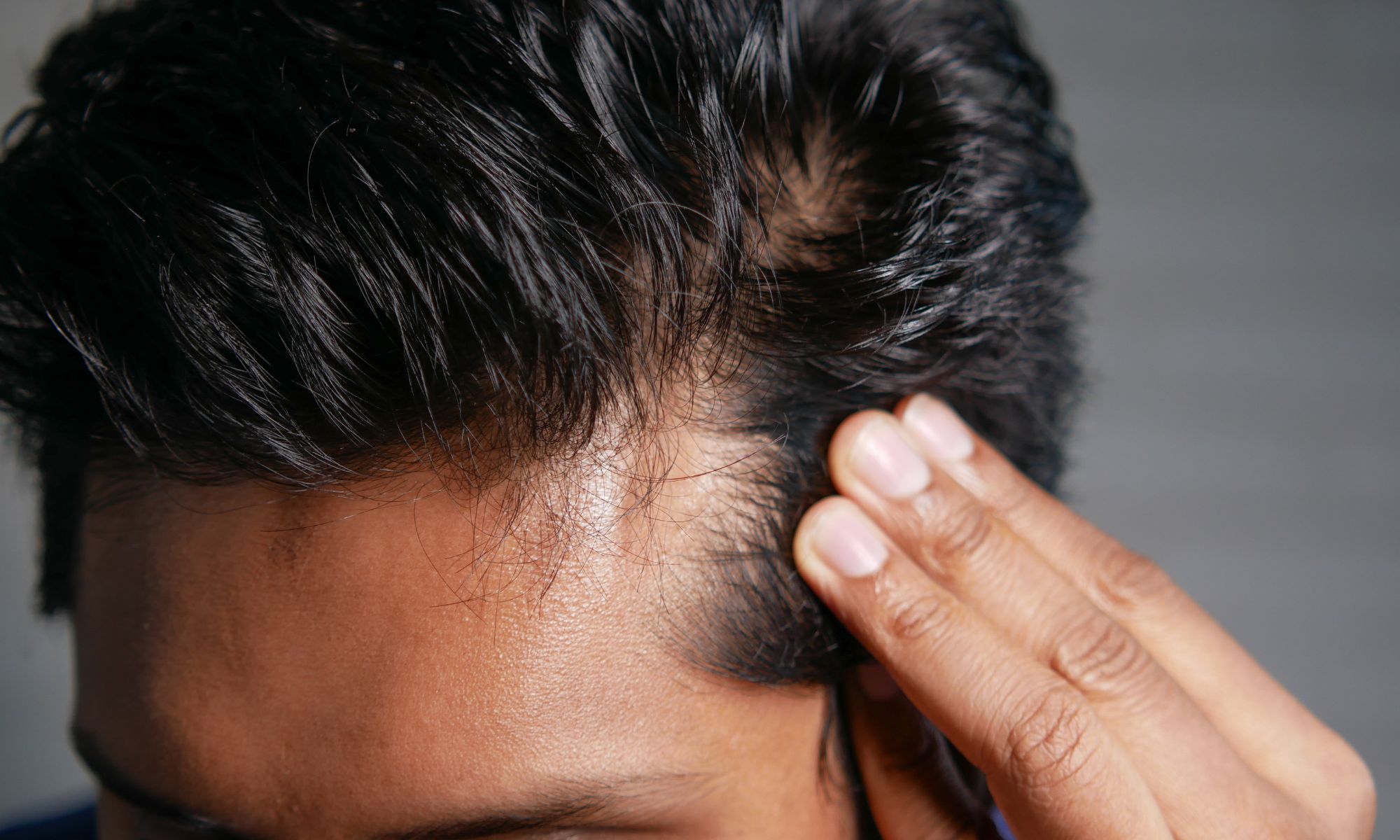 August is Hair Loss Awareness Month